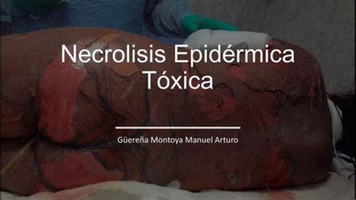 ¿Por qué es tóxica la carne de tiburón?